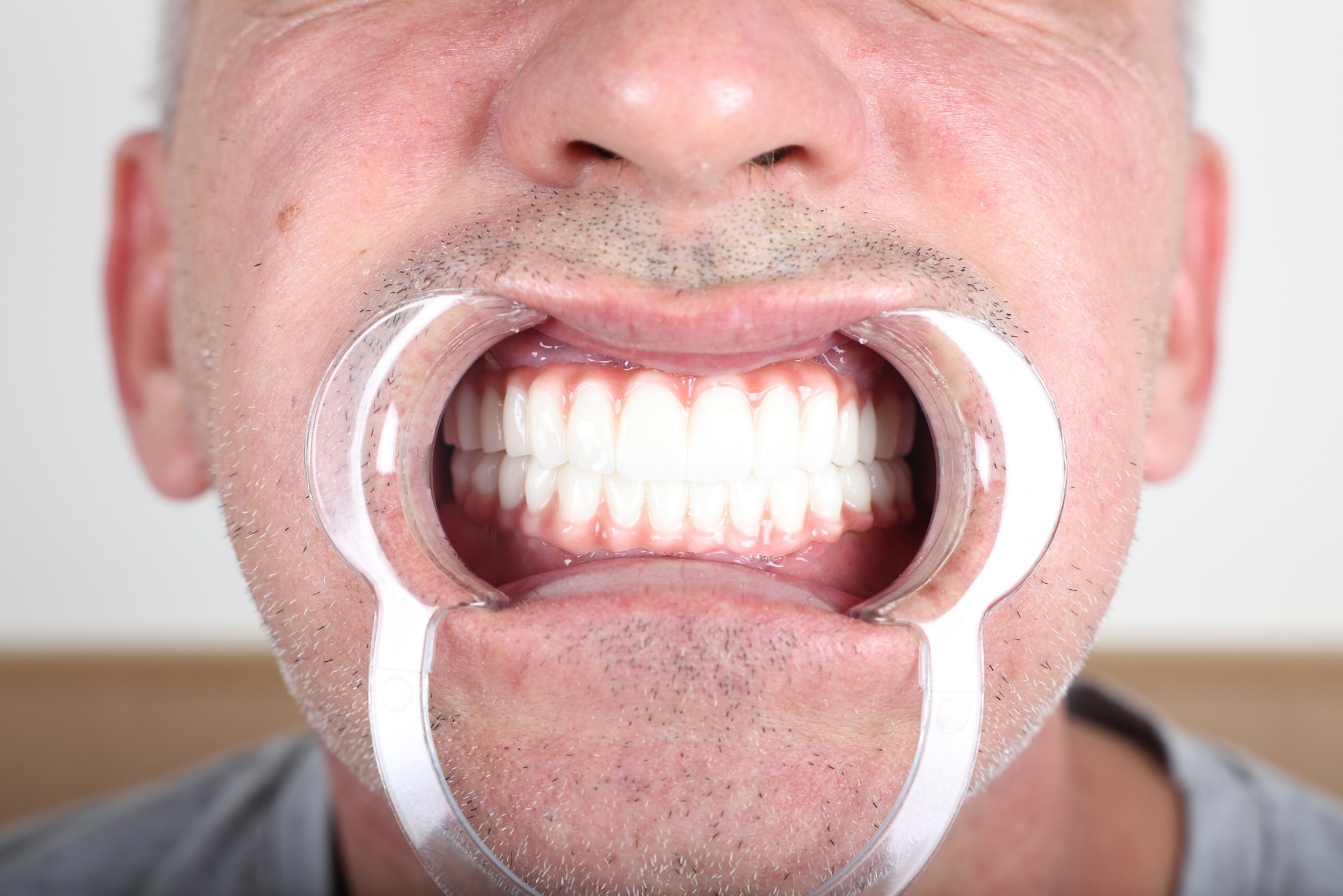 After All-on-6 Implant Treatment